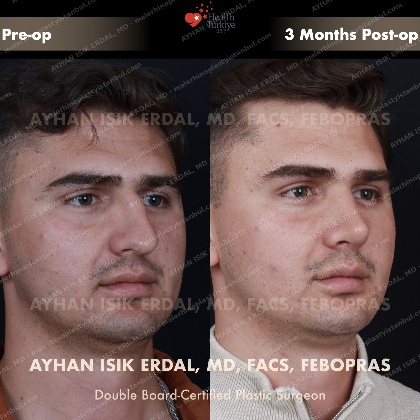 Male rhinoplasty before and after — three-quarter view, Case 2