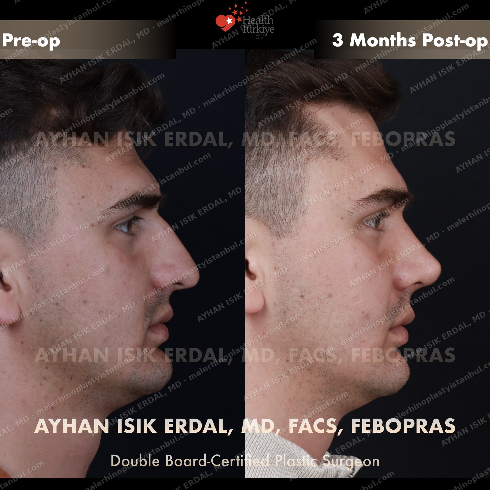 Male rhinoplasty before and after — profile view, Case 2