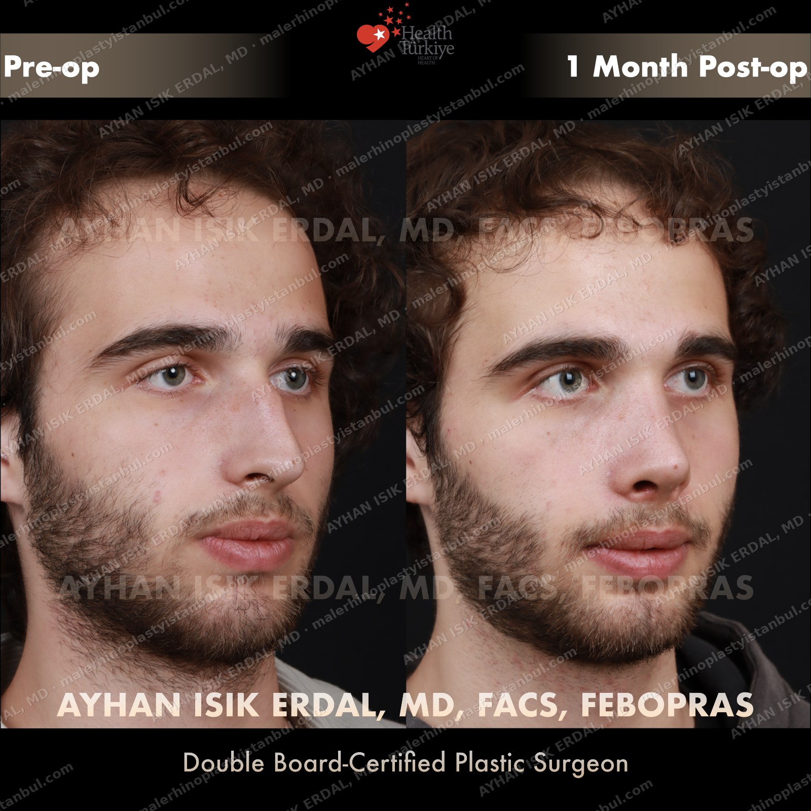 Male rhinoplasty before and after — profile, Case 3