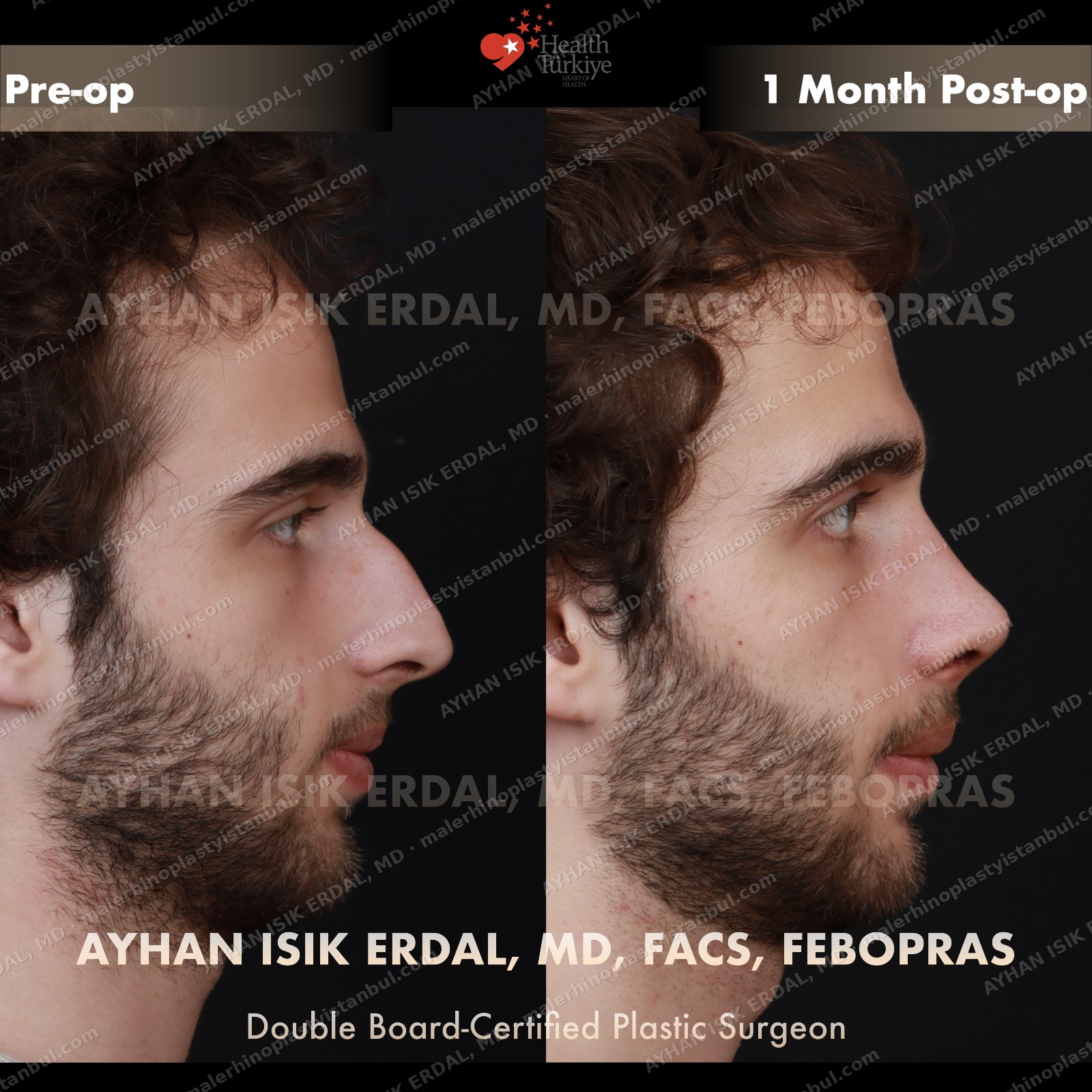 Male rhinoplasty before and after — opposite profile, Case 3