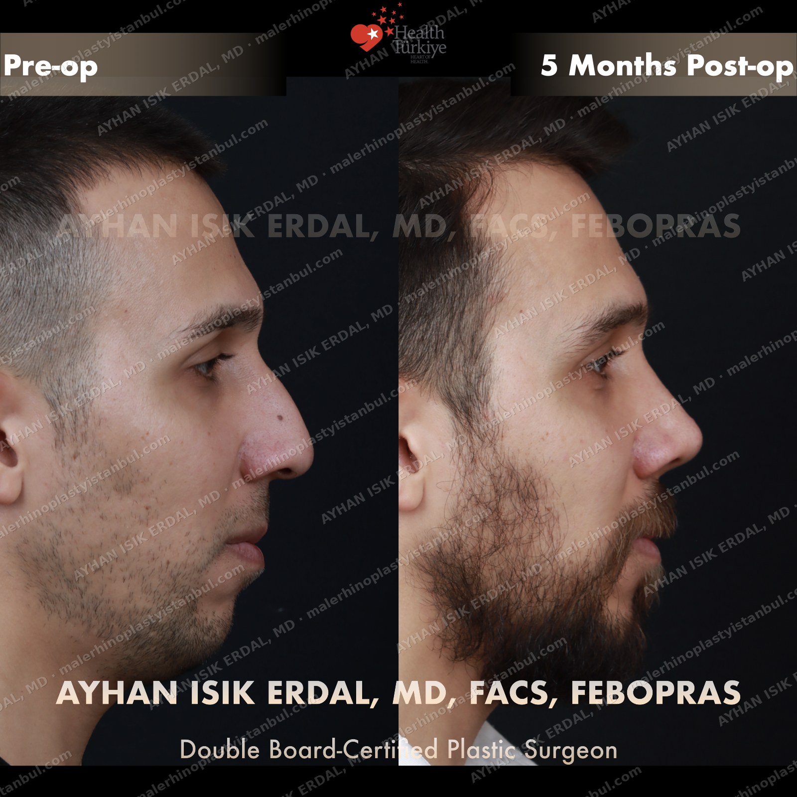 Male rhinoplasty before and after — profile, Case 4
