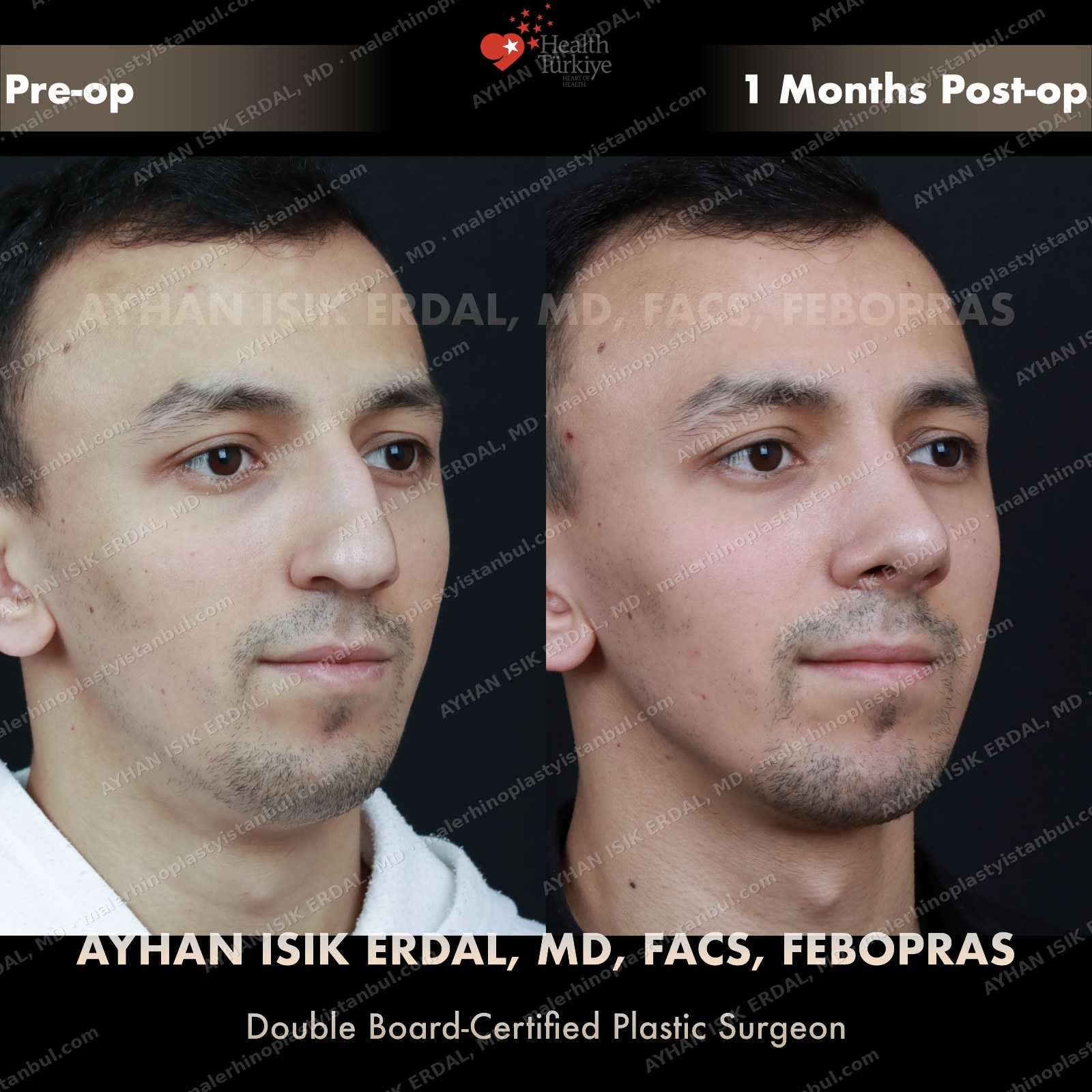Male closed septorhinoplasty before and after — profile, Case 5